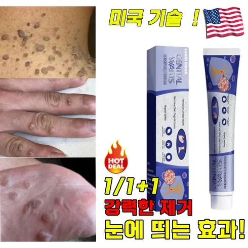 티눈제거 맞춤상품 8가지